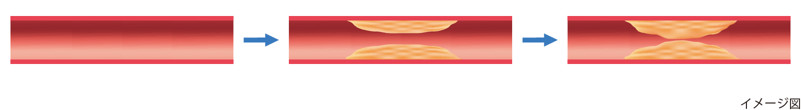 図1 動脈硬化症の発症メカニズム