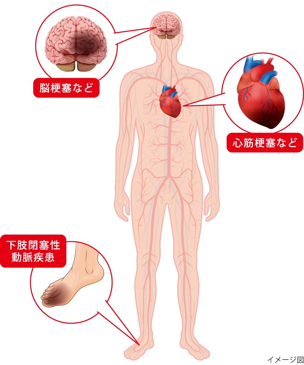 図2 三大動脈硬化症